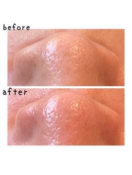 ニコリ(nicori)/ワックス脱毛で毛穴洗浄