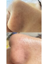 エレガンテ(ELEGANTE)/鼻の黒ずみ、たった一回で