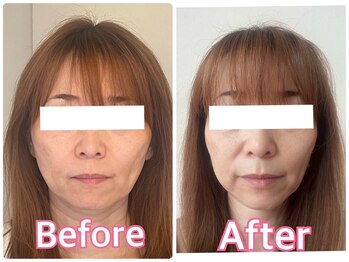小顔矯正サロン ブルーム/フェイスラインと頬のコケを改善