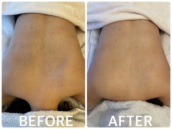 ハーブピーリング 心斎橋/背中ニキビ改善