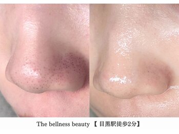 ザ ベルネス(The bellness)/【毛穴洗浄】東京/目黒駅