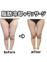 エルズ(L’s)/脂肪冷却