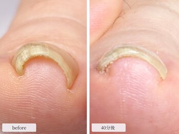 ディグニティ(Dignity)/巻き爪改善ケア(初回→40分後)