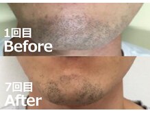 バーニー 梅田店(BARNEY)/ヒゲ脱毛の効果(7回目)/顔脱毛