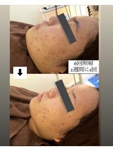 ノイ(Noi)/プラズマ＆針状の成分導入　