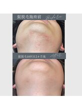 レオナルド(Leonardo)/効果絶大のヒゲ脱毛！