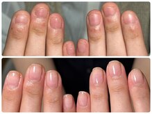 1人で悩むのはもう終わり“自爪本来の美しさ”を目指しましょう