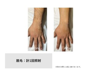 スタンド(STAND)/うで脱毛