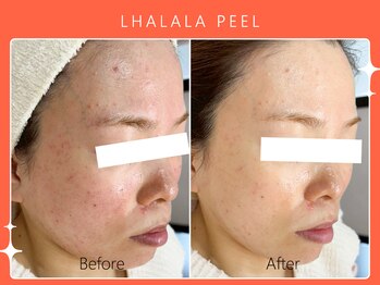 シロカネ イオンタウン西熊本店(SHIROKANE)/韓国肌管理ララピール☆