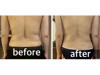 リムアール(Limh R)/ビフォーアフター