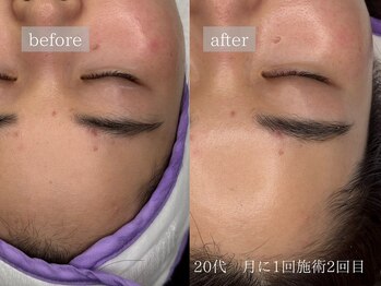 レオン(Leon)/ビフォーアフター