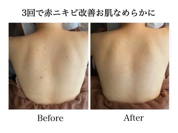 ナチュラーレ 天王寺店(Naturale)/美肌ニキビケア背中ブライダル