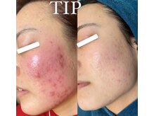 ビーピー 渋谷(b.p.)/TIPハーブピーリング