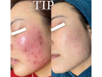 ビーピー 渋谷(b.p.)/TIPハーブピーリング