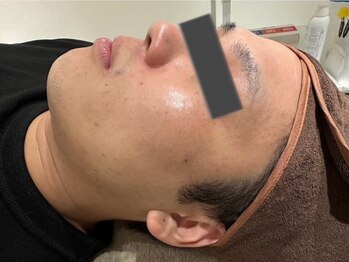 ピュアーム(Pure-m)の写真/エクソソーム専門店◆男性のお肌/髪の悩みを解消◎毛穴洗浄でザラザラ肌をスッキリ!育毛促進を実感