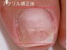 【巻き爪でお困りの方へ】アクリルで巻き爪とサヨナラ！￥1650～