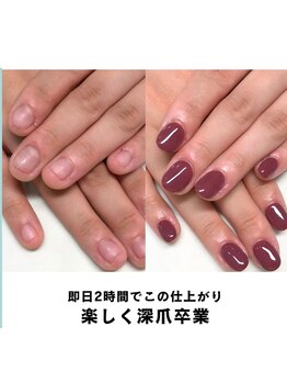 ティアラネイル 宇都宮/深爪矯正