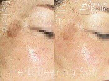 ベル 栄(Belle)/ハーブピーリング｜ニキビケア