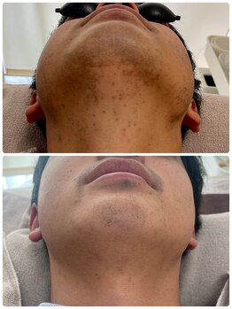 プレジール(PLAISIR)/ヒゲ脱毛