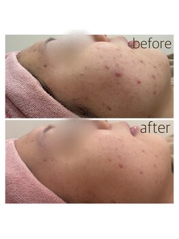 ペルボヌール 深井店/ハーブピーリング剥離なし1回