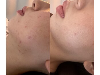 けんたろう鍼灸院の写真/＼大人気の鬼美容鍼／小顔だけにとどまらずニキビ改善・たるみ改善にも効果◎その肌悩みもう繰り返さない！