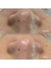 韓国式3D毛穴洗浄+鼻、眉間Wax