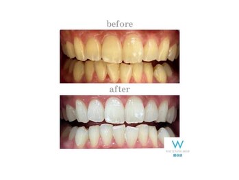 ホワイトニングショップ 越谷店/before&after美白ホワイトニング