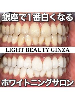 ライトビューティー 銀座店(LightBeauty)/東銀座 ホワイトニング症例写真