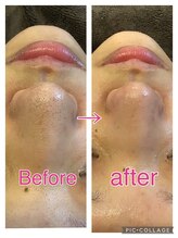 リジュベ(Rejuve)/毛穴洗浄/毛穴エステ/船橋毛穴