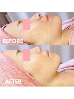 シフォン(Chiffon)/リフトアップコースで肩まで