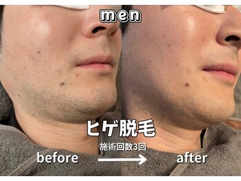キュー(cue)/【メンズ】「ヒゲ脱毛」3回