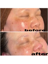 ブルーム(BLOOM)/REVI陶肌トリートメント