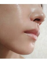 ラミーユ(La Miu)/剥離なしハーブピーリング