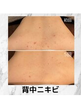 チェンジ(Change)/背中ピーリング