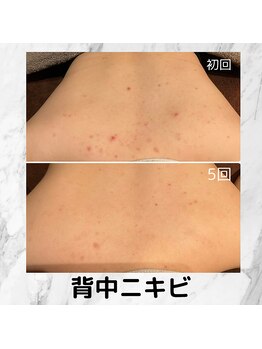 チェンジ(Change)/背中ピーリング