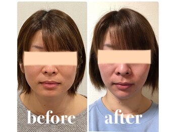 クリーム 京都店(Cream)/ダイエットしても顔だけ痩せない