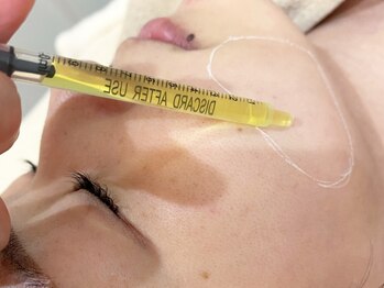 ハティア(hattia)の写真/ダウンタイム無！頑固な二重アゴや頬肉解消◎【脂肪分解レモンボトル】導入ケアで小顔に★初回お試し¥9900