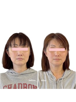 ニコディア(nico-dia)/美容鍼