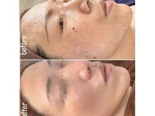 プラスワン(plusone)の雰囲気（当店人気の肌デトックスハーブピーリング】）