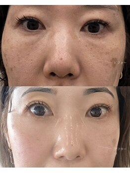 エス ルクール(S.Lecoeur)の写真/1回で変わる水光肌｜シミ・しわ改善・毛穴をまとめてケア