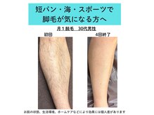 ダーウィン(Darwin)/メンズ膝下脱毛