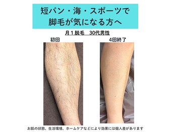 ダーウィン(Darwin)/メンズ膝下脱毛