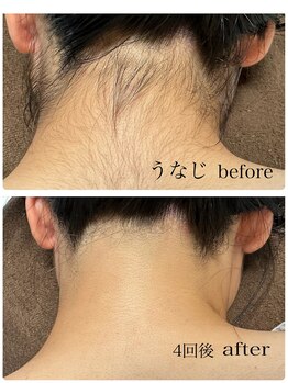 ナブラ デュオ(NABLA Duo)/レディース脱毛