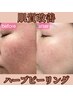 【赤ら顔改善/毛穴レス/ノーファンデ肌】ハーブピーリング¥25300→¥19800