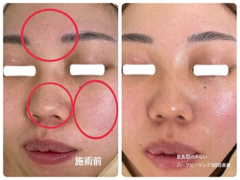 フェイシャルエステ エムズルーム(M's room)/肌負担が少ないハーブピーリング