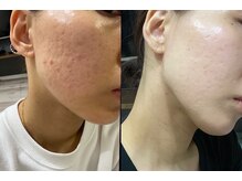 ナナラ(nanala)/当店取り扱いのスキンケア★