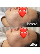 ピエール ナリタイラボ 薬院店(Piel NARITAI LABO)/小顔矯正の変化♪