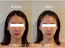 ミベル(MeBell)/小顔コルギ＋セラピール　1回