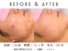 ロエヴェ(ROEWE)/ニキビ改善・毛穴ケア・肌質改善