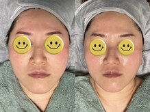 ホワイティアビシェル 浦和(Whitia Vishell)/【フェイシャル】小顔リフト